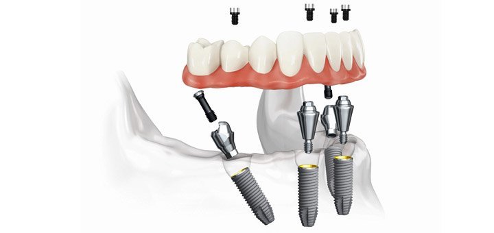 Promotion for professional dental services in the clinic of aesthetic medicine «Ex Tempore»